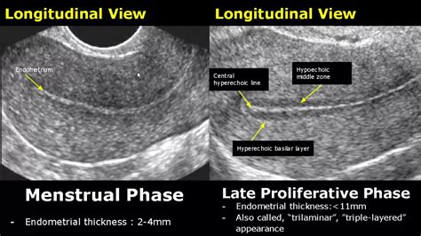 measuring endometrial thickness with fluid|normal endometrial thickness ultrasound.